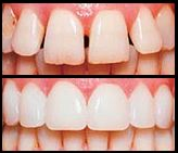 WhatвЂ™s The Latest With Veneers?