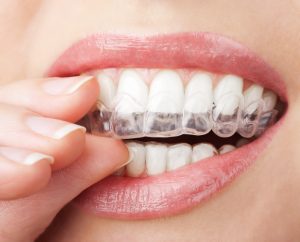 Facts for Patients Interested in Getting Invisalign